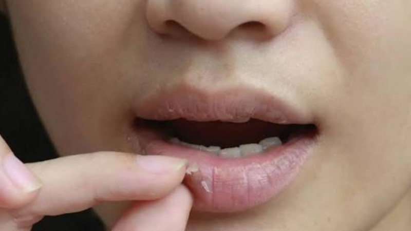 cara mengatasi bibir pecah pecah